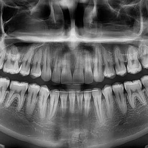 Panoramsko snimanje zuba - Ortopan - MM Scan Novi Sad